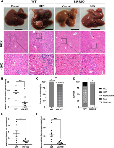 Figure 5 Ulk1 deficiency prevents DEN-induced HCC. (A) Representative macroscopic images and HE-stained liver sections of mice from different groups at 32 weeks of age [scale bar, 1 cm, 100 μm (100×), 20 μm (400×)]. (B) Numbers of macroscopically detectable nodules at the liver surface in DEN-treated WT and Ulk1KO mice. n = 7 to 12, ***P < 0.001. (C) Tumor incidence in DEN-treated WT and Ulk1KO mice, statistical analysis was conducted using Fisher’s exact test (n = 7 to 12). (D) Percentage of mice with foci, hyperplasia, HCA, and HCC in WT and Ulk1KO mice. Statistical analysis was conducted using the Mann–Whitney U-tests (n = 7 to 12), *P < 0.05. The maximal diameters (E) and accumulated diameters (F) of tumors per mouse were measured (n = 7 to 12), **P < 0.01. ***P < 0.001.