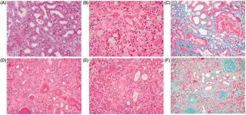 Figure 3. Renal pathology for hematoxylin–eosin, periodic acid-Schiff’s reagent, periodic acid methenamine, and Masson’s trichrome staining of patients in group 1 (A–C) and group 2 (D–F) (200×): it could be seen from the contrasts of pathology of the two groups that the patients in group 2 had more chronic lesion such as more serious degree of fibrosis and more inflammatory cell infiltration.
