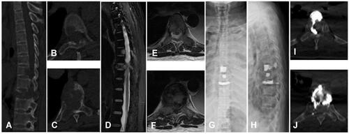 Figure 3 A 59-year-old male with lung cancer who treated with PVP suffered from intra-spinal canal cement leakage. (A) CT sagittal plane showed T8 and T10 destructions; (B) CT horizontal plane of T8; (C) CT horizontal plane of T10; (D) MRI sagittal plane showed T8 metastatic lesion and T10 metastatic spinal cord compression; (E) MRI horizontal plane of T8; (F) MRI horizontal plane of T10; (G and H) postoperative X-ray; (I) CT horizontal plane of T8 showed intra-spinal canal cement leakage; (J) CT horizontal plane of T10 showed intra-spinal canal cement leakage.