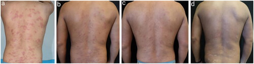 Figure 3. Changes in skin lesions on the back from before to after treatment in Patient 1. (a) Before treatment. (b) Two weeks after starting treatment. (c) One month after starting treatment. (d) Six months after starting treatment.
