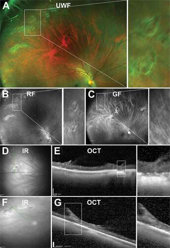 Figure 12. 29 year old Caucasian male with snail track degeneration in the superotemperal peripheral retina. (A) UWF imaging (B) red-free and (C) green-free imaging highlights closely spaced circular lesions forming a ‘track’. (D) Infra red imaging and associated (E) peripheral OCT highlights thinning and a wrinkled inner retina. In some cases, (F - G) traction can be observed. Abbreviations as in Figure 3.