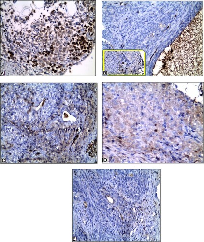 Figure 6. Immunohistochemical expression of ki-67 in different groups: A) Control group showing strong immunopositive staining in granulosa cells. B) PCOS-IR model group showing Ki-67 nuclear expression mainly in the theca cells and nearly absent in granulosa cells (higher power figure is inserted in the left box). C) MET-treated group showing ki-67 expression mainly in granulosa cells. D) SeNPs -treated group showing ki-67 expression mainly in granulosa cells. E) SeNPs + MET-treated group showing higher ki-67 expression and is present mainly in granulosa cells. Magnification: × 400.