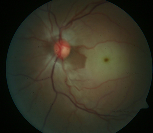 Figure 2 Left eye fundus photography taken at presentation of a twenty-nine-year-old male who presented with sudden painless loss of vision of less than ten hours prior to presentation. The visual acuity was counting fingers, showing a more severe central arterial occlusion with a more prominent cherry-red spot, significant macular edema, and pallor. Findings are suggestive of a subtotal CRAO. He had surgical intervention approximately fifteen hours after symptom onset. At two months post-surgery Snellen visual acuity in the left eye was 6/36.