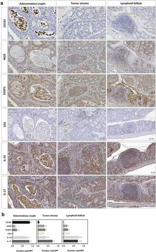 Figure 5. ST11 K. pneumoniae promoted the accumulation of immune cells in different sub-tumoral regions. (a) Representative images showing the distribution of immune cells in three sub-tumoral regions, adenomatous crypts, tumor stroma, and lymphoid follicles, of the adenomas developed in the AOM-DSS mice with ST11 K. pneumoniae co-administration. (b) HistoQuest Software quantified positive rates of CD163+, iNOS+, IL-10+, IL-17+, or Foxp3+ immune cells in each sub-tumoral region high-powered field in 5 randomly selected areas for ≥3 tumors of individual mice (n = 6). Data are presented as mean ± SD