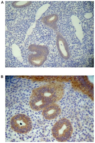Figure 7 Immunohistochemical grading of Cox-2 expression in the eutopic endometrium of patients with adenomyosis. (A) 1+ expression and (B) 3+ expression.