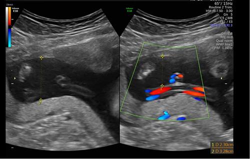 Figure 2 Example A of the assessment of amniotic fluid volume using gray scale on the L side of the screen and color Doppler on the R side of the screen and measurement of the amniotic fluid pocket.