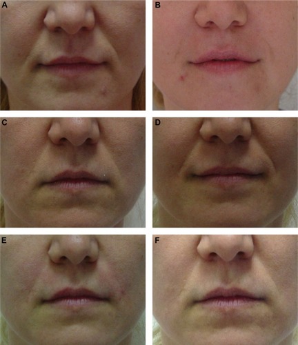 Figure 4 A 38-year-old female (Wrinkle Severity Rating Scale grade 4) before and after application of 0.8 mL/side of cross-linked carboxymethyl cellulose and reapplication of 0.6 mL/side at Month 9.