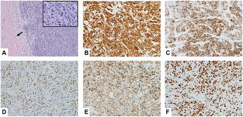 Figure 3 Pathologic Evaluation of Resected Tumor. The H&E sections (A, x 10) show the proliferation of neoplastic lymphocytes adjacent to the periosteal soft tissue (arrow); and neoplastic lymphocytes are large with open chromatin and prominent nucleoli; mitosis is brisk (inset, x 40). They are positive for CD20, CD10, BCL6, BCL2, with a high proliferative rate by Ki-67, 90% (B–F, x 20).