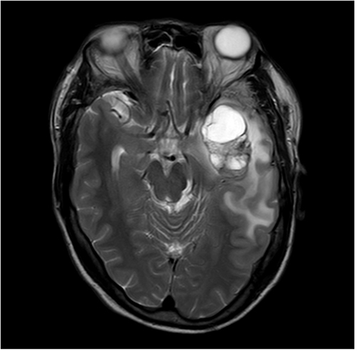 Figure 2 Male (44 years old) with headache and blurred vision for one month. T2WI showing the internal hemorrhage of the mass with high signal intensity and perilesional edema/infiltration.