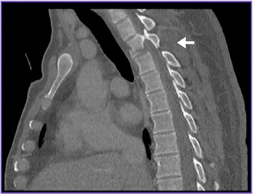 Figure 1 Sagittal computed tomography (CT) image with T2 vertebral body fracture with locking of the right T2-T3 facet joint (Arrow).