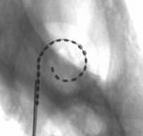 Figure 15. MRA (version 6) microfocus fluoroscopy showing excellent final positioning and depth of the array. Images courtesy of CRC Hear, Melbourne, Australia.