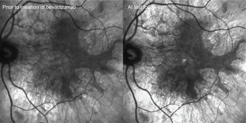 Figure 4 Infrared photos captured prior to initiating anti-vascular endothelial growth factor therapy (bevacizumab) and at last follow-up.