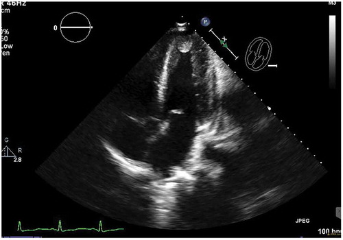 Image 2 ECHO:Non contrast apical four chamber view showing echo density in the left ventricular apex which represents thrombus vs mass