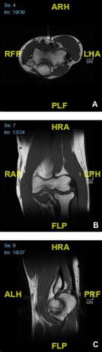 Figure 2 Right elbow MRI. No evidence of soft tissue mass or abnormal marrow signal: axial view (A), coronal view (B), and sagittal view (C).