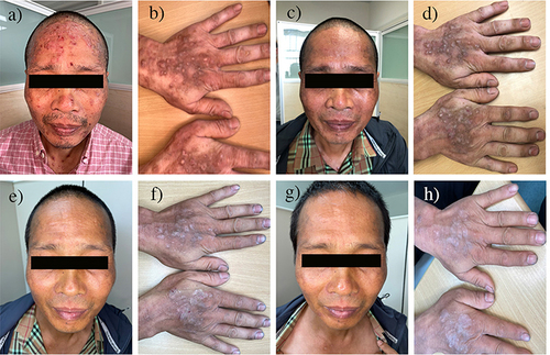 Figure 1 Characterization of Lesions Throughout the Treatment Course. (a and b) hypertrophic and infiltrating nodules of varying sizes on face and hand; (c and d) During the first revisit, the patient reported improved symptoms, including alleviation of itching and a decline in rash; (e and f) during the 2nd revisit after treatment; (g and h) During 4th revisit, rash was almost imperceptible and pruritus was no longer prominent.