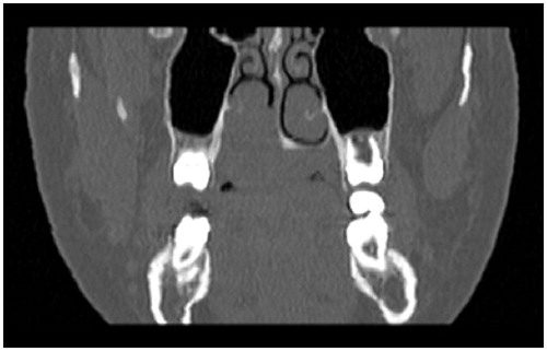 Figure 2. CT scan (coronal view) showing a left irregular mass of the hard palate with bone erosion.