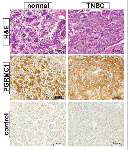 Figure 1. Representative images of hematoxylin and eosin stained sections and PGRMC1 expression in non-malignant breast tissue and triple negative breast cancer (TNBC) from the same patients. Samples of normal mammary tissue (left panels) and TNBC (right panels) were hematoxylin and eosin stained or stained for PGRMC1 expression by immunohistochemistry (n = 3 individual patients). Some sections (bottom panels) were used as negative controls in which primary antibody was omitted.