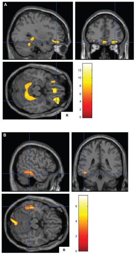 Figure 1 (A) Smaller gray matter volumes in patients with Alzheimer’s disease and delusions (n = 18) than in those without delusions (n = 35) on both sides of the parahippocampal gyrus, both sides of the orbitofrontal cortex, and both sides of the medial frontal gyrus ventromedial prefrontal cortex. (B) Smaller gray matter volumes in patients with Alzheimer’s disease without delusions (n = 35) than in those with delusions (n = 18) in the left inferior temporal gyrus and the right cerebellum.