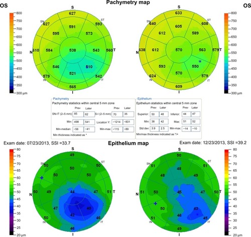 Figure 3 Anterior segment optical coherence tomography derived preoperatively and 5 months postoperatively showing corneal thickness and epithelial maps of the central 6 mm of the cornea in patient 3 (all units in microns [um]).