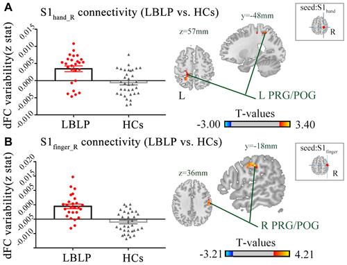 Figure 3 Differences in the alterations of dFC between LBLP patients and healthy controls (two-sample t-test, two-tailed, voxel-level P < 0.01, GRF correction, cluster-level P < 0.05).Notes: (A) Increased dFC between the right S1hand cortex and the left PRG/POG in LBLP patients. (B) Increased dFC between the right S1finger cortex and the right PRG/POG in LBLP patients.Abbreviations: dFC, dynamic functional connectivity; LBLP, low-back-related leg pain; HCs, healthy controls; PRG, precentral gyrus; POG, postcentral gyrus; S1hand_R, representation of the right hand in the primary somatosensory cortex; values of sFC are the mean ± SEM.