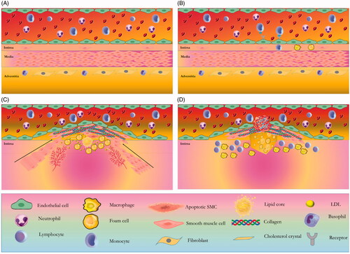 Figure 1. Four stages in the atherosclerotic lesion formation. (A) In the normal and healthy situation, the normal artery has three layers. The intima layer or the inner layer consists of a monolayer of endothelial cells and resident smooth muscle cells (SMCs). The tunica media or the middle layer has several layers of SMCs which are embedded in a complex extracellular matrix. The adventitia, the outer layer, contains microvessels, nerve endings, mast cells, and fibroblasts. (B) The first stage is ECs activation through metabolic susceptible risk factors such as hyperlipidemia, adhesion of blood leukocytes such as monocytes to the activated monolayer of ECs, migration of monocyte into the intima, maturation of monocytes into macrophages, phagocytosis of LDL cholesterol that causes the formation of foam cells and phospholipid oxidation. (C) In the second stage, inflammatory condition and mediator effect leads to infiltration of SMCs from the media to the intima. High proliferation of media-derived SMCs and resident intimal SMCs, and an elevated production of extracellular matrix macromolecules, such as proteoglycans, elastin, and collagen leads to plaque formation. SMCs and plaque macrophages may die in advancing lesions through apoptosis. Extracellular lipid derived and apoptotic bodies from dying and dead cells can exacerbate the inflammatory condition. Advancing plaques also contain microvessels and cholesterol crystals. (D) The third and final stage is atherosclerotic plaque rupture and thrombosis, where it can impede blood flow.