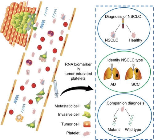 Figure 5 A schematic figure summarizing potential role of platelets in NSCLC.Notes: Platelets communicate with tumor cells through uptaking of tumor-associated biomolecules and thus may serve as a potential diagnostic marker for NSCLC.Abbreviations: AD, adenocarcinoma; NSCLC, non-small-cell lung cancer; SCC, squamous cell carcinoma.