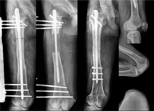 Figure 4 (case 22). The 16-year-old male patient underwent the procedure of femoral lengthening over an intramedullary nail. A satisfactory lengthening of 6.5 cm was achieved. However, lateral subluxation of the patella occurred in knee fiexion.