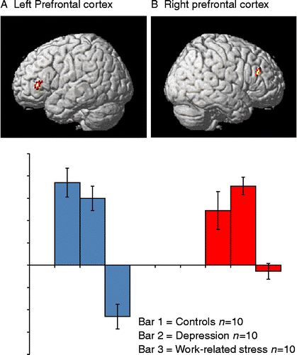 Figure 2.  (A) Brain regions with significant activation differences during n-back vs. baseline. The reported activations were significant at a voxel level of p < 0.001, uncorrected for multiple comparisons, with an extent of >5 contiguous voxels. Reduced activation was found in the left ventrolateral prefrontal cortex (vlPFC, local maxima x, y, z = − 32, 34, 8) for stress group compared to depressed patients and controls. Blue bars show the mean activity levels in 2-back for controls, depression, and work-related stress on the left, center, and right, respectively. Error bars indicate SEM and ± 95% CI. (B) Brain regions with significant activation differences during n-back vs. baseline, showing relatively less activation in the right dorsolateral prefrontal cortex (dlPFC, local maxima x, y, z = 26, 32, 24) for the work stress-related LTSL group compared to depressed subjects and controls. Red bars show mean activity levels during 2-back for controls, depression, and work-related stress on the left, center, and right, respectively. Error bars indicate SEM and ± 95% CI. The singular images are overlaid on a standard MRI template.