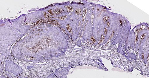 Figure 3 Immunohistochemical staining of skin lesions (CD68×4).