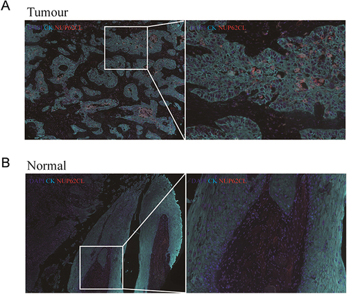 Figure 2 The multiplex immunohistochemistry revealed the expression of the NUP62CL protein in tumor tissues (A) and normal tissues (B).