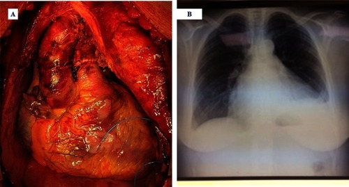 Figure 1 The picture shows a heart transplantation (sternotomy) with autologous pericardium (A) and our patient in position for a standard PA (posterior-anterior) chest x-ray (B).