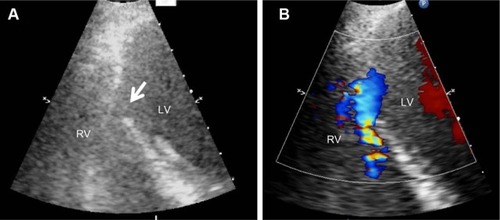 Figure 2 Echocardiography on admission.Notes: Echocardiography showed muscular VSD of approximately 2 cm size. (A) Ventricular septal defect (arrow) and (B) further delineation with use of color-flow Doppler.Abbreviations: LV, left ventricular; RV, right ventricular; VSD, ventricular septal defect.