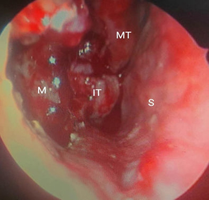 Figure 3 Intra-operative nasal endoscopy.