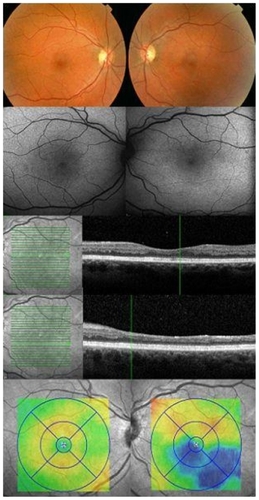 Figure 3 A raster cut through the inferior temporal retina and the retinal thickness map show marked thinning of inner retina (blue color) in the area of the inferior temporal branch artery obstruction in the left eye not identified on color photographs or autofluorescence study (Case 3).