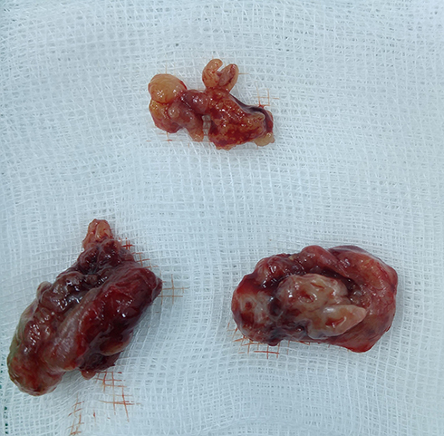 Figure 1 Gross examination of the palatine and pharyngeal tonsils, all with an unusually grey-yellowish, elastic, almost cartilaginous aspect.