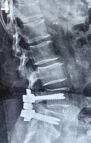 Figure 4 Posterior fixation and fusion at the L4-L5 level.