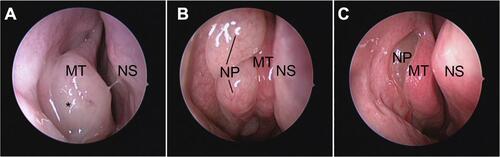 Figure 2 The endoscopic characteristics of CCAD, ENP, and NENP. (A), Middle turbinate polyposis in CCAD; (B and C) middle meatus polyps in ENP (B) and NENP (C).