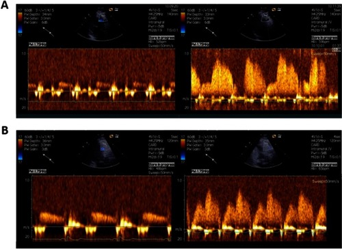 Figure 2 Examples of CFR assessed by transthoracic Doppler of the mid-distal portion of LAD. Coronary flow reserve is calculated as the ratio of mean diastolic coronary flow velocity at hyperemia (induced by intravenous infusion of adenosine 140 µg/min/kg) to that in the resting condition. (A) Doppler flow recording in LAD from patients with normal CFR (4.6), (B) Doppler flow recording in LAD from patients with decreased CFR (1.7).