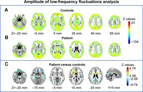 Figure 4 Amplitude of low-frequency fluctuations analysis. (A) Average gray matter resting fluctuations amplitude in the healthy controls. (B) Gray matter resting fluctuations amplitude in the patient. (C) Between-group comparison of patient versus controls via Z-transformation.