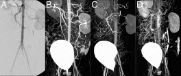 Figure 1. Abdominal angiograms obtained via intra-arterial transcatheter delivery of contrast agents. The x-ray angiogram (A) provides a useful anatomical reference for the MR acquisitions (B-D). All MR acquisitions were designed to achieve a blood concentration of 2% contrast. Injection of more dilute contrast at higher rates (B-20% contrast at 1.7 mls/s) produced markedly better results than more concentrated variants (C-50% contrast at 0.7 mls/s, D-100% contrast at 0.4 mls/s). Note-the bladder is clearly evident on all the projection MR angiograms as a result of contrast accumulation during the study.