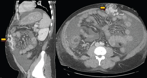 Figure 1. Computed tomography images showing a parietal varicose veins secondary to the permeabilization of the umbilical vein (yellow arrow).