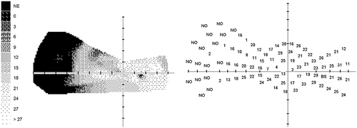 Figure 2 Distal nasal part of the visual field in POAG with a 17-point drop out.