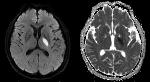 Figure 1 MRI of a new infarction in basal ganglia regions.