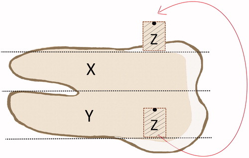 Figure 1. Schematic drawing of tooth and dentin specimens: axial cut giving sections X, and Y, the area for collecting the dentin cylinder specimen Z, and how the specimen Z was orientated and placed on section X. The non-test side of specimen Z was marked with black permanent marker for orientation.
