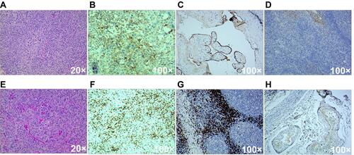 Figure 1 Pathology, PD-L1/CD8 staining images of postoperative tissues. (A) H&E staining of postoperative tissues of the first operation; (B) PD-L1 22C3 IHC staining of the patient’s postoperative tissues after recurrence; (C) Positive control of PD-L1 22C3 staining; (D) Negative control of PD-L1 22C3 staining; (E) H&E staining of postoperative tissues after recurrence; (F) CD8 staining of the patient’s postoperative tissues after recurrence; (G) Positive control of CD8 staining; (H) Negative control of CD8 staining.