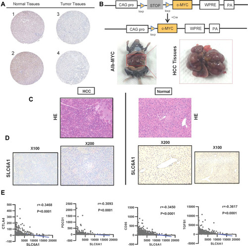 Figure 4 The protein level and immune checkpoint analysis of SLC6A1 in HCC: (A) Immunohistochemistry analysis shows the expression of SLC6A1 on protein by the Human Protein Atlas database. (B) The intercrossing of Myc and Alb-Cre mice through Cre/loxP transgenic technology (C) The Inspection of cell morphology changes in Alb-Cre/Myc mouse HCC tissues and WT mouse normal tissues through HE staining. (D) Immunohistochemistry analysis compared the expression of SLC6A1 on protein level in Alb-Cre/Myc mouse HCC tissues and WT mouse normal tissues. (E) The closely negative correlations between SLC6A1 and T cell exhaustion (CTLA-4, PD-L1)/Monocyte (CD86) in liver cancer tissues.