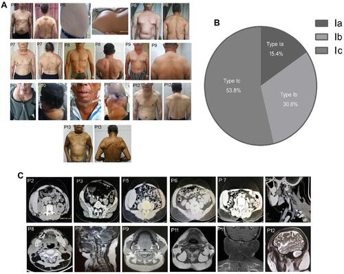 Figure 1 Distribution of the MSL adipose tissues and image examinations. (A) Photographs of the clinical phenotype in these 13 MSL patients, and adipose tissue accumulated in the nuchal region, upper thorax, both upper arms, shoulders, abdomen, and the back in P1 to P6 and P13 patients, in the nuchal region and shoulders adipose tissues in P7, P8, P9, and P12 patients, and in the nuchal region in P10 and P11 patients. (B) MSL clinical classification according to the adipose tissue distribution. (C) Images of adipose tissue accumulation. The CT image data shows that abdomen adipose tissues only occur in the subcutaneous but not visceral locations in P1 to P6 and P13 patients, and CT images of the adipose tissues in the nuchal region and the anterior and posterior neck in P8 and P9 patients and MRI in P11 and P12 patients.
