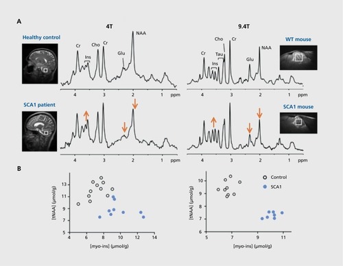 Figure 5. Parallel neurochemical alterations in patientsCitation134 (left) and transgenic wild-type (WT) mouse modelsCitation133 of neurodegeneration (right). (A) Singlevoxel 1H MR spectra obtained from the cerebellum of a patient with spinocerebellar ataxia type 1 (SCA1)and a mouse with the same genetic mutation are shown in comparison to their respective healthy controls. Total N-acetylaspartate (NAA) and glutamate are lower and myo-inositol higher than controls in both cases. (B) Concentrations of NAA and myo-inositol obtained from individual subjects distinguish the SCA1 and control groups with no overlap in both humans and the mouse model.