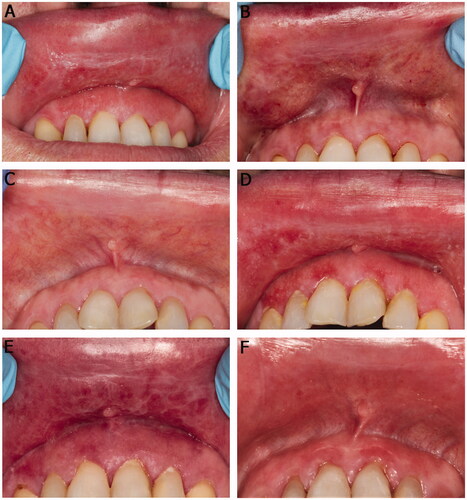 Figure 3. Clinical presentation of the upper labial mucosa and upper anterior labial gingiva over a 10-year span (A, B, D, and E). White reticular striae or papular lesions with erythema were seen at most visits. (C) A faint white stria to the labial mucosa after treatment with intralesional methylprednisolone (40 mg/ml) injection. (F) Slight erythema of the labial mucosa and gingiva on the last follow-up visit. The patient used tacrolimus when needed.