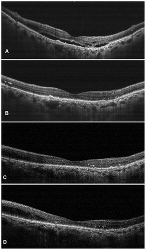 Figure 2 Representative case of nAMD who had previously received multiple anti-vascular endothelial growth factor (anti-VEGF) injections with suboptimal outcomes. After switching to intravitreal injection (IVI) brolucizumab, the patient demonstrated complete resolution of the subretinal and intraretinal fluid at weeks 4 (B) and 8 (C) as compared to the baseline (A). Early recurrence was noted at 12 weeks (D) for which the patient underwent second dose of IVI brolucizumab.